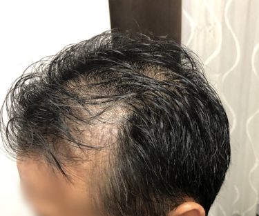 AGA治療で毛が増えたけど、やめたらどうなる？